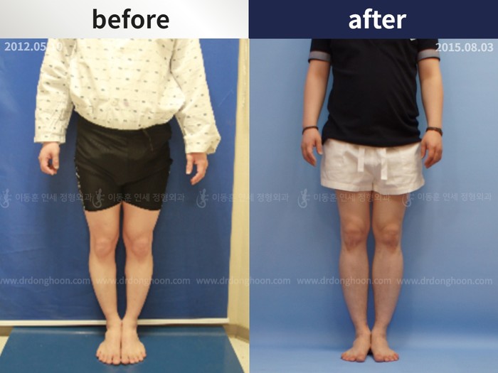 Tibial lengthening