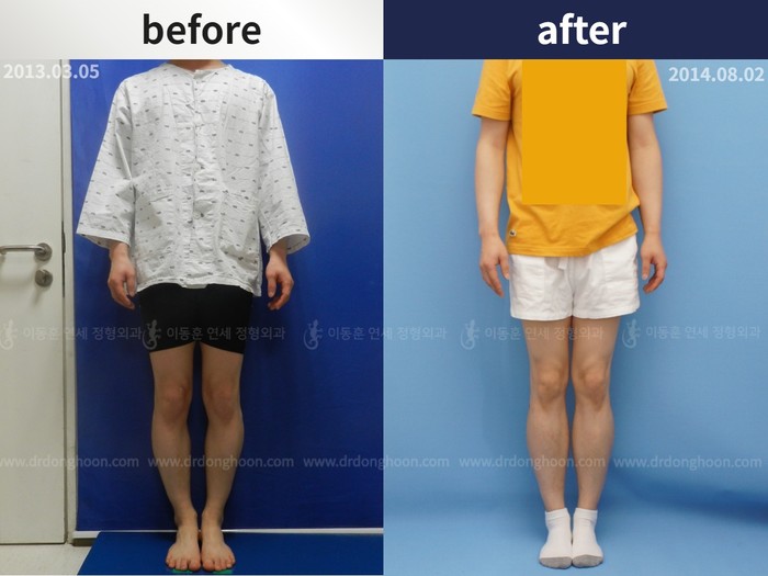 Tibial lengthening