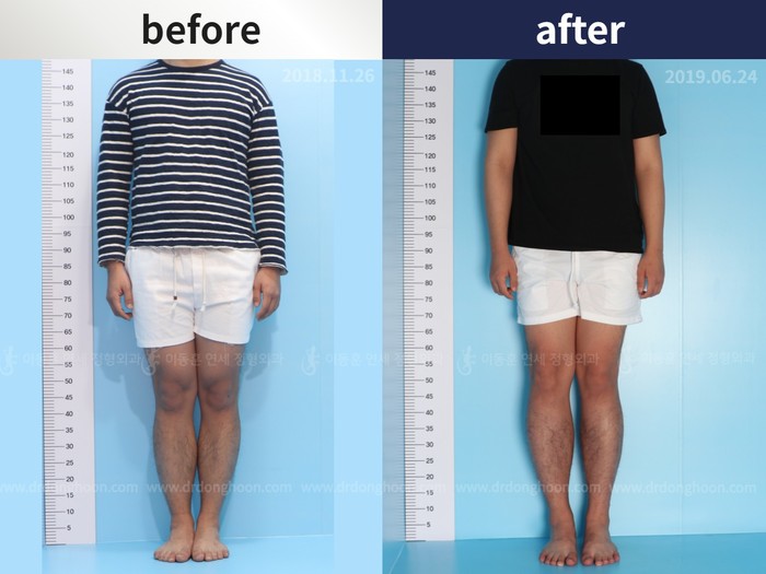 Tibial lengthening, 5.7 cm gained