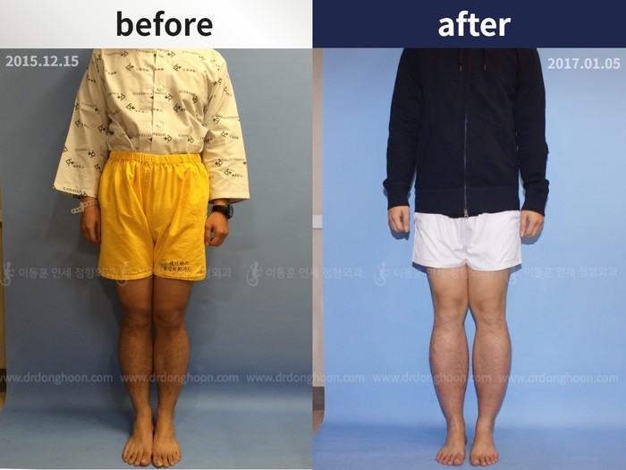 Tibial lengthening