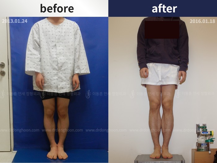 Tibial lengthening