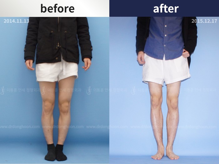 Tibial lengthening