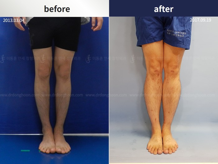 Tibial lengthening