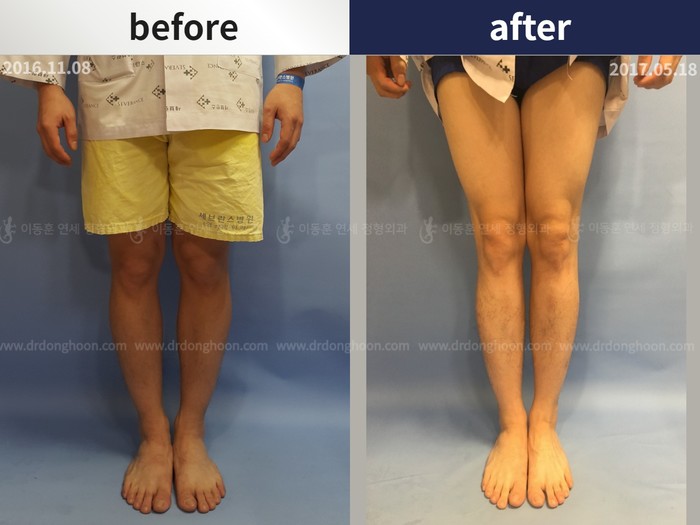 Tibial lengthening