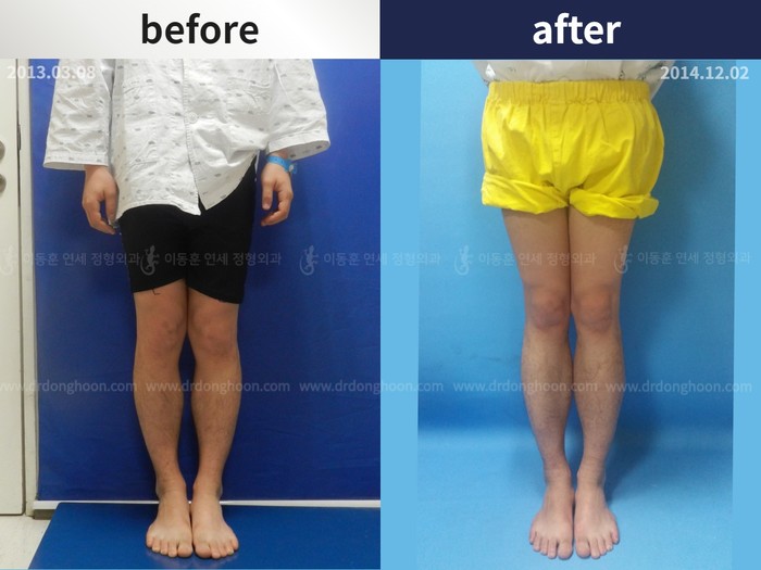 Tibial lengthening