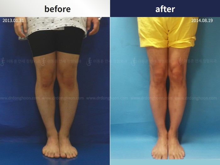 Tibial lengthening