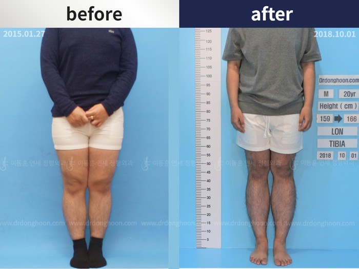 Tibial lengthening, 7 cm gained