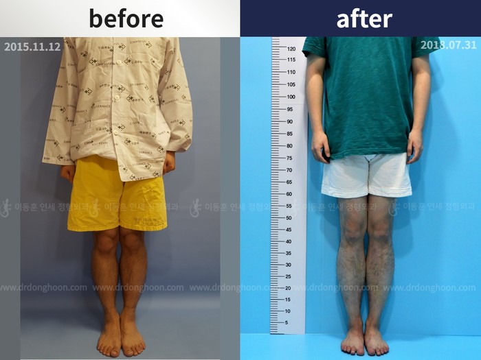 Tibial lengthening