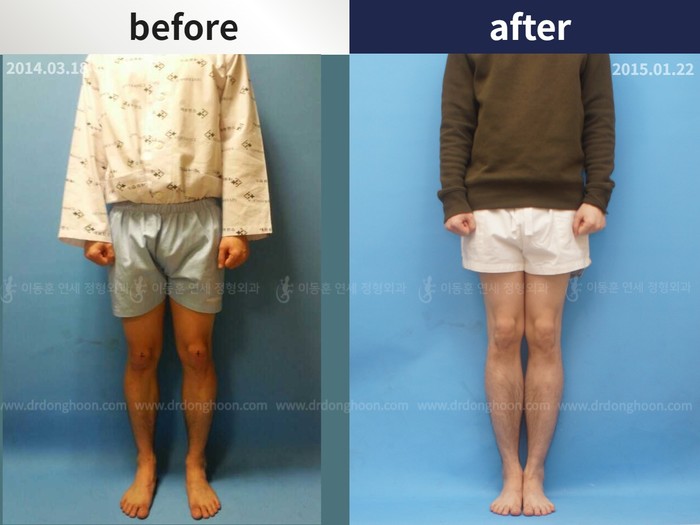 Tibial lengthening, 6 cm gained