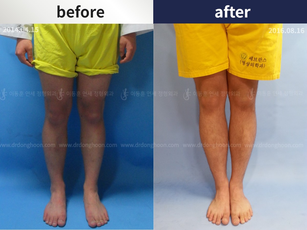 Tibial Lengthening Using LON : DALRI Before & After