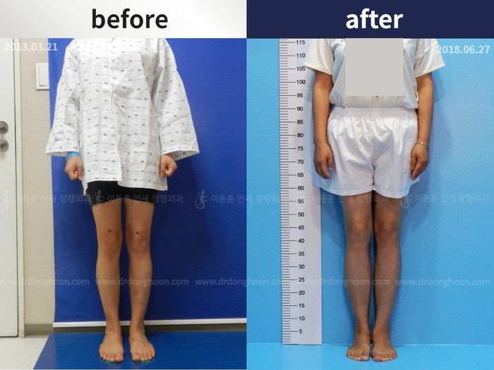 Tibial lengthening