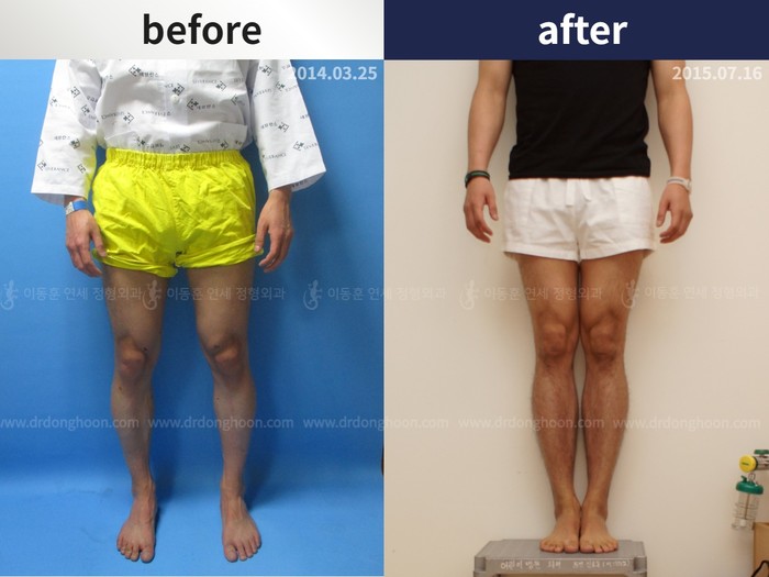 Tibial lengthening, 6 cm gained