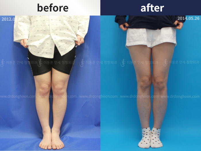 Femoral + tibial lengthening, 5 cm gained