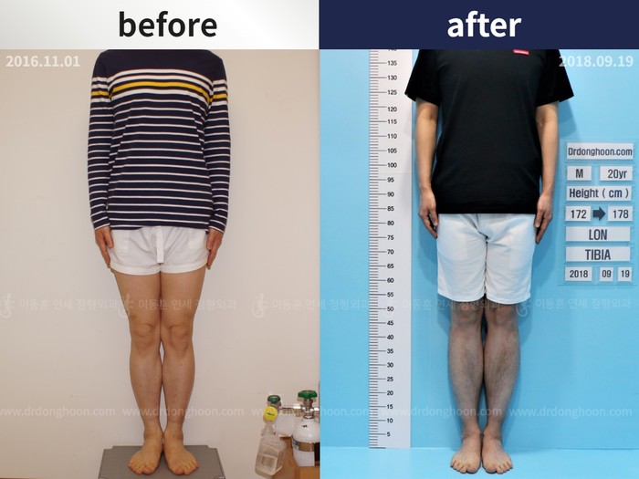 Tibial lengthening, 6 cm gained