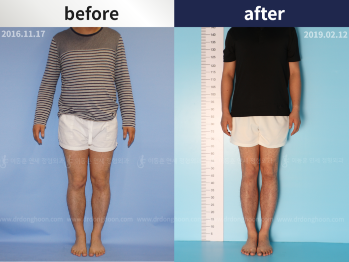 Tibial lengthening, 6 cm gained
