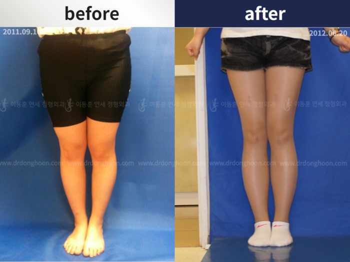 Femoral + tibial lengthening, 5 cm gained