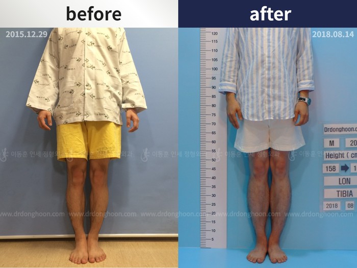 Tibial lengthening, 7 cm gained