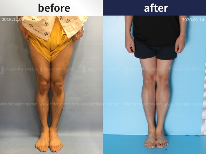 Tibial lengthening