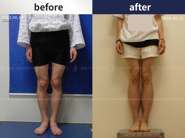 Tibial lengthening, 7 cm gained