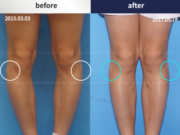 Protruded fibular head