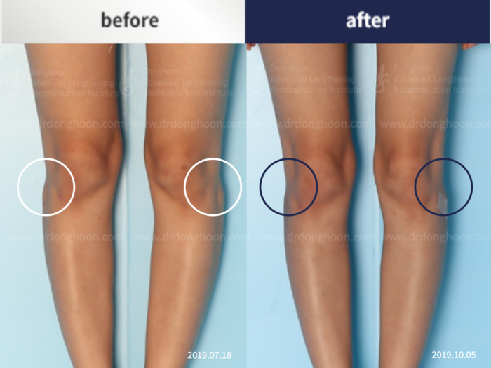 Protruded fibular head