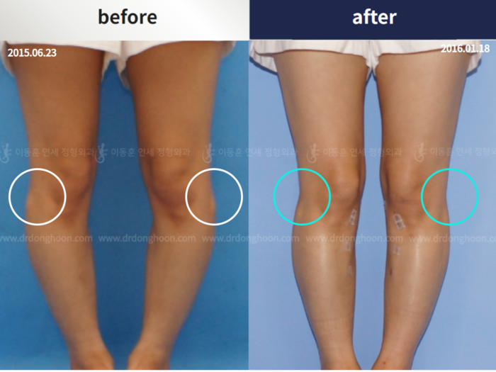 Protruded fibular head