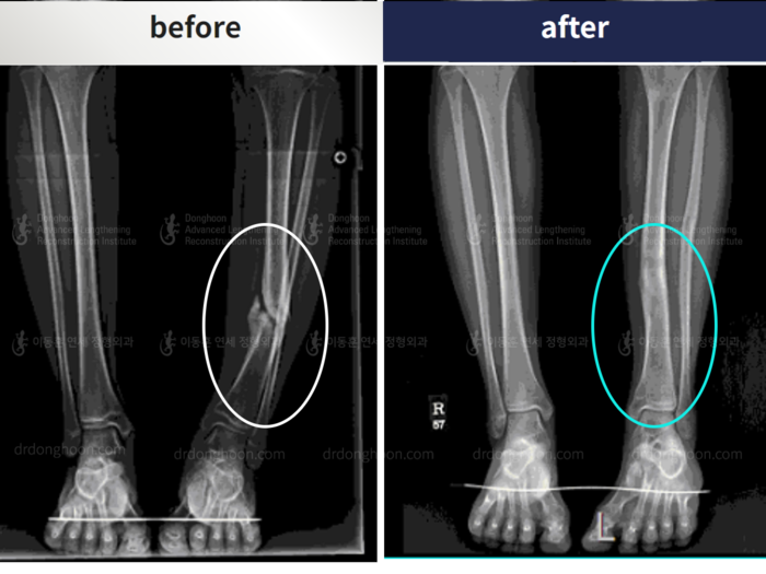 Arm, foot & ankle before and after radiograph example 2