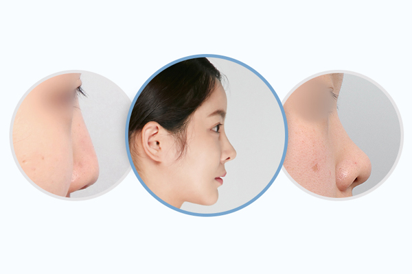 Chiều cao của mũi đẹp tùy thuộc vào chóp mũi