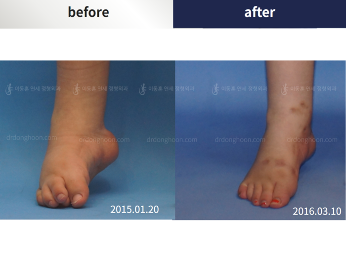 Foot & ankle deformity
