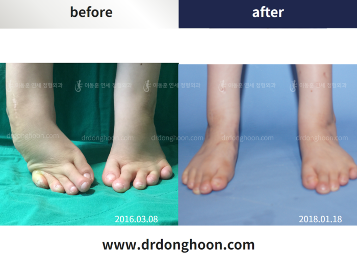 Foot & ankle deformity