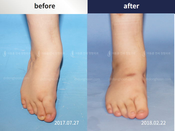 Foot & ankle deformity
