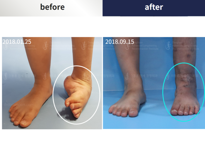 Foot & ankle deformity