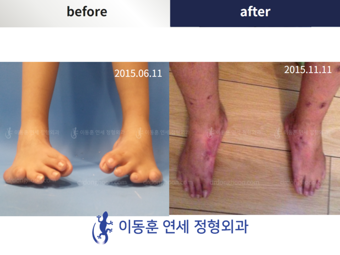 Foot & ankle deformity