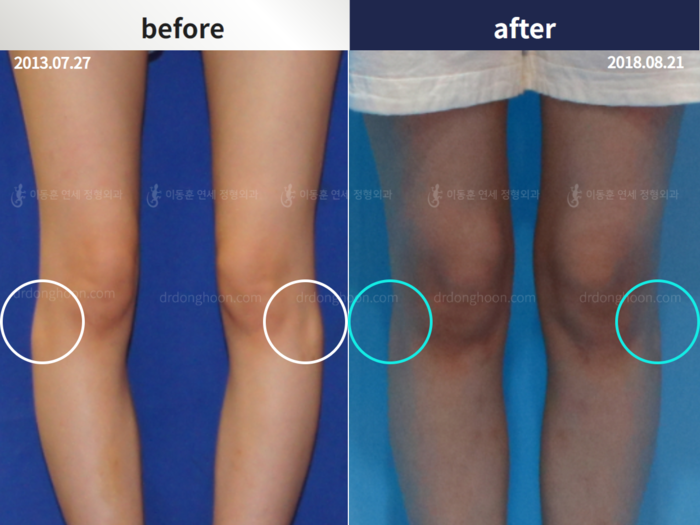 Protruded fibular head