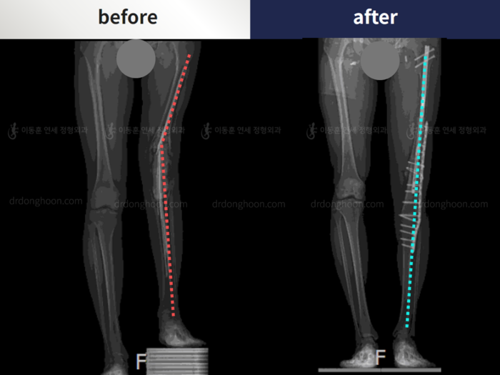 Post-trauma deformity