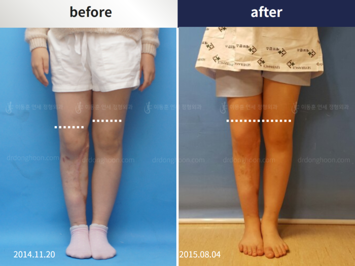 Post-trauma deformity