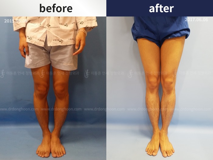 Tibial lengthening