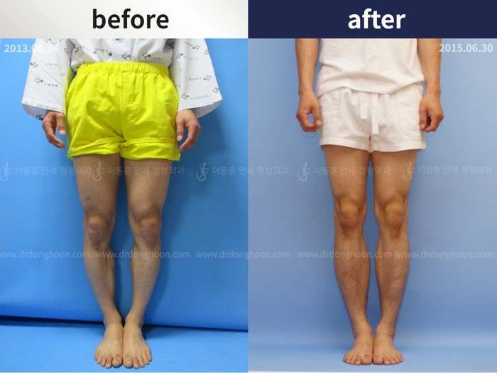Tibial lengthening, 5.5 cm gained
