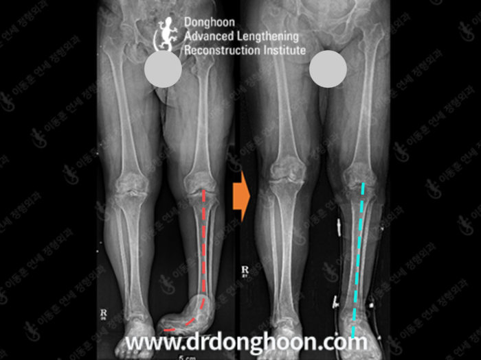 Arm, foot & ankle before and after radiograph example 1