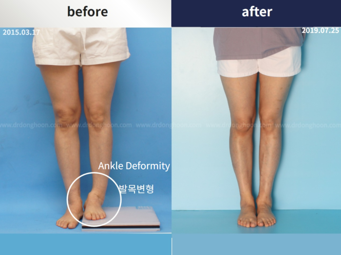 Tibial lengthening
