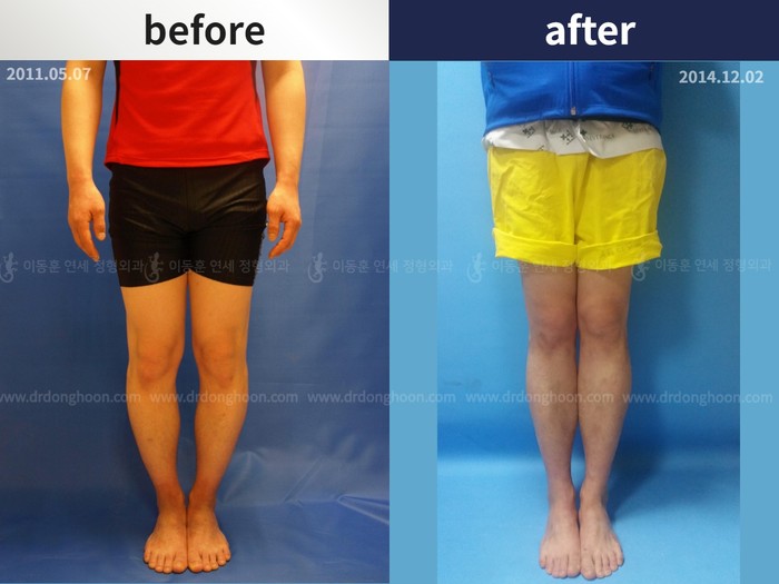 Tibial lengthening, 6 cm gained