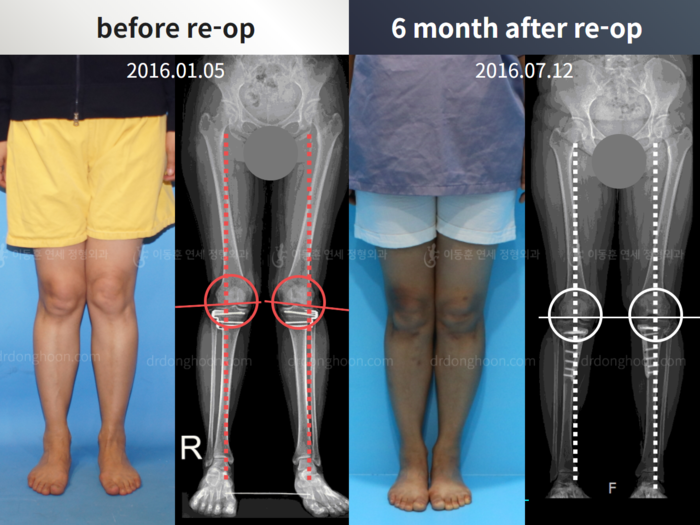 Reoperation after deformity correction