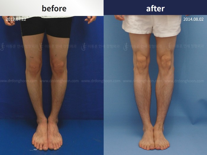 Tibial lengthening
