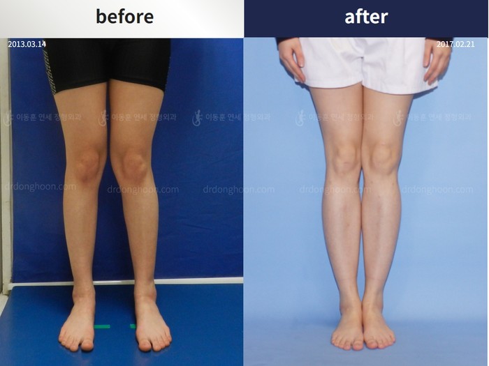 Tibial lengthening