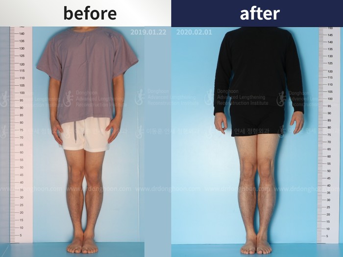 Tibial lengthening