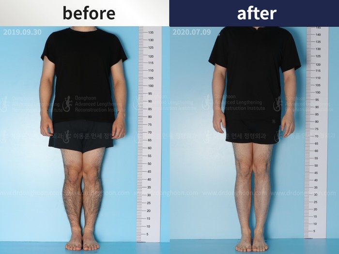 Tibial lengthening, 6.4 cm gained
