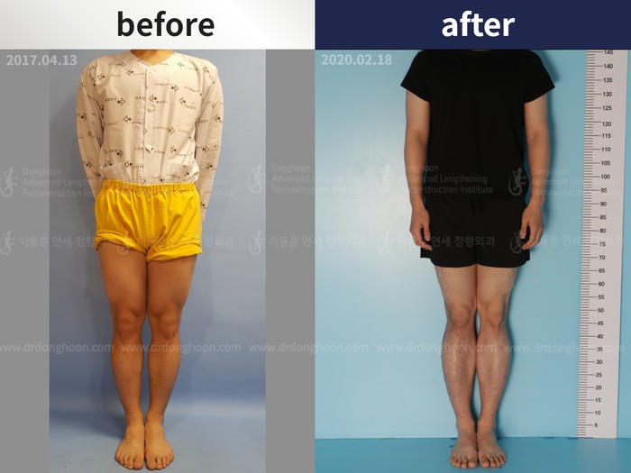 Tibial lengthening