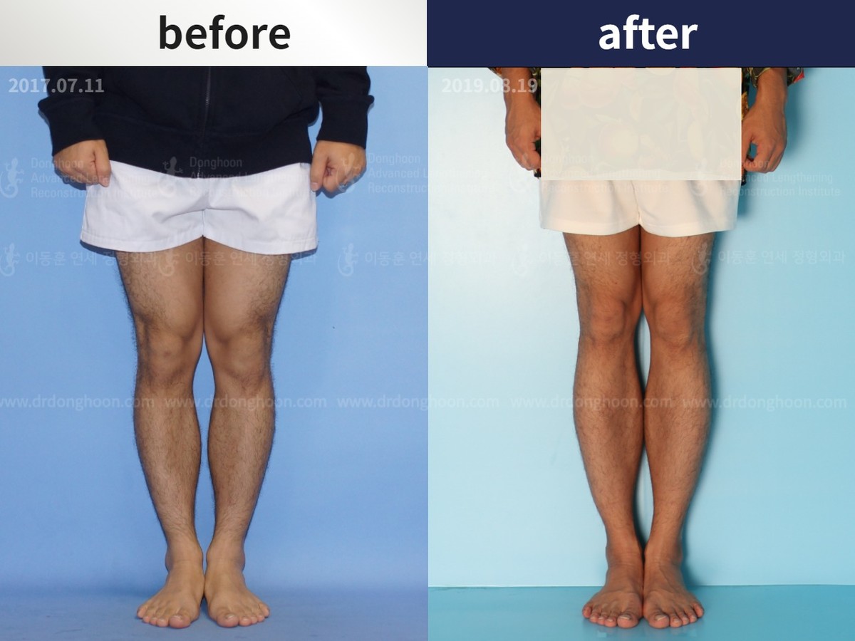 Tibial Lengthening Using LON : DALRI Before & After