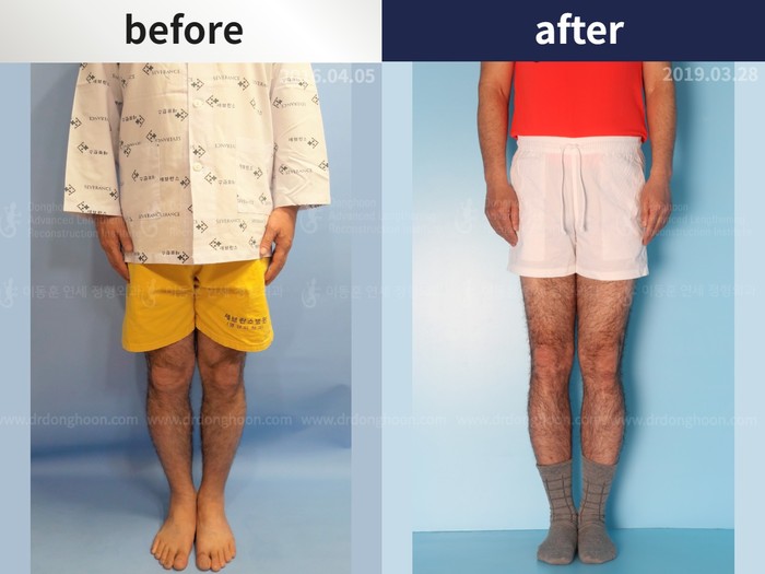 Femoral + tibial lengthening