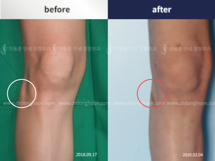 Protruded fibular head